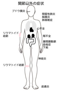 関節以外の症状