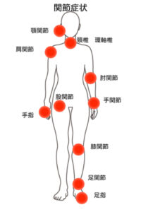 関節症状の分布