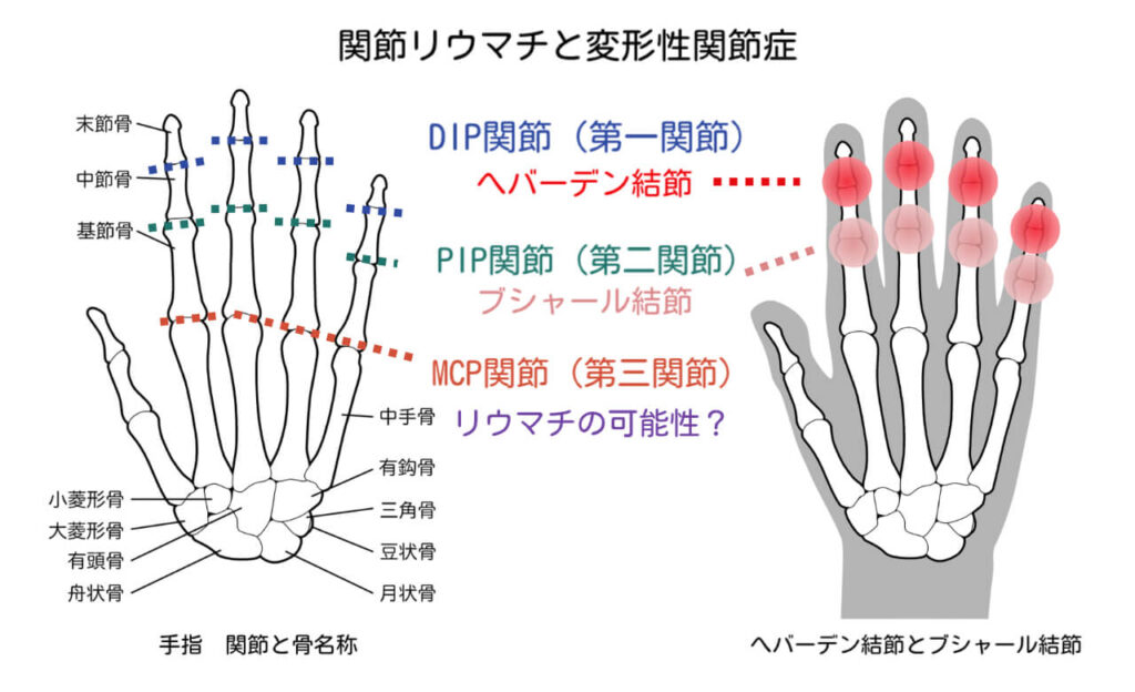 朝のこわばり　指の変形性関節症