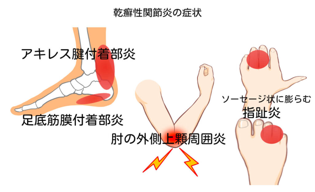 乾癬性関節炎の症状