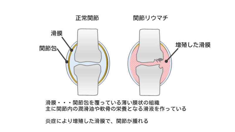 関節リウマチと関節の構造